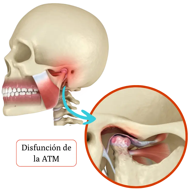 Disfunción de la articulacion temporomandibular