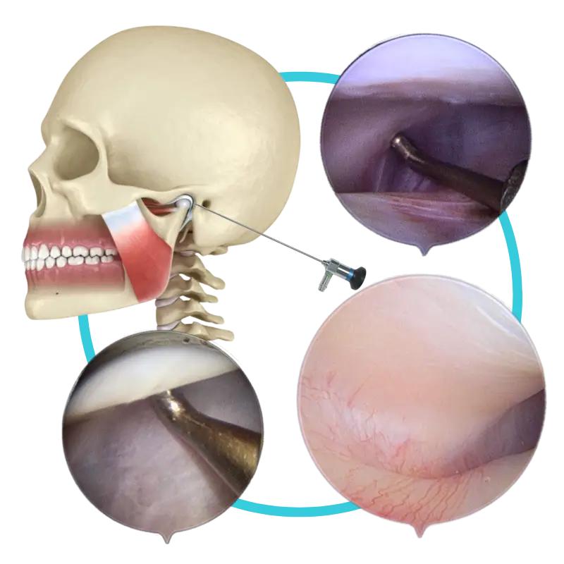 Artroscopia de la articulación temporomandibular