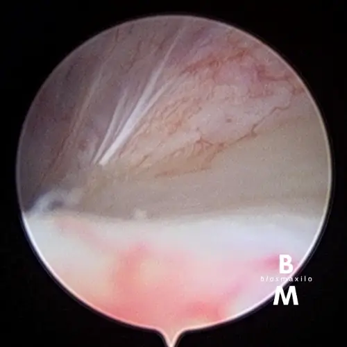 Osteoplastia artroscópica de la pared medial y anteromedial