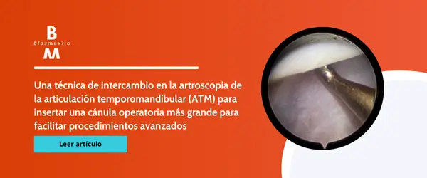 Una técnica de intercambio en la artroscopia de la articulación temporomandibular (ATM) para insertar una cánula operatoria más grande para facilitar procedimientos avanzados